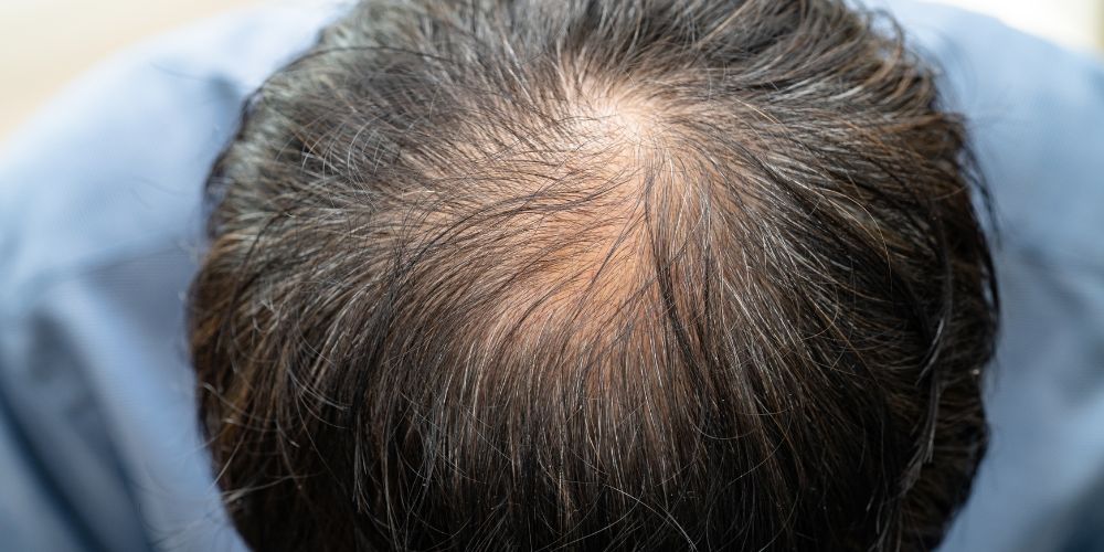 crown-hairline